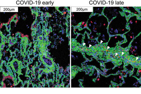 New High-Resolution Imaging Technology Reveals COVID-19 Lung Pathology in Space and Time | Mucosal Immunity | Scoop.it