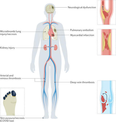 Understanding COVID-19-associated coagulopathy | Nature Reviews Immunology | Immunology | Scoop.it