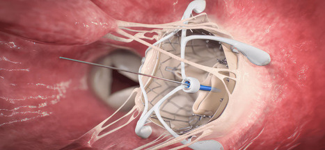 Mitral valve repair with resection and non-resection techniques in Barlow's disease | Transcatheter Treatment of Mitral Regurgitation | Scoop.it
