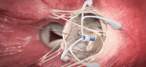Mitral valve repair with resection and non-resection techniques in Barlow's disease | Transcatheter Treatment of Mitral Regurgitation | Scoop.it