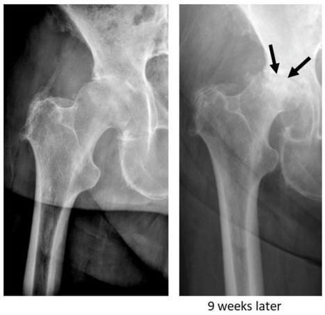 JCM | Free Full-Text | Vitamin D Deficiency Is Frequent in Patients with Rapidly Destructive Osteoarthritis—Data from a Single-Center Analysis | Rheumatology-Rhumatologie | Scoop.it