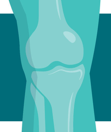 APOE in fat pad and synovium contributes to knee OA | Nature Reviews Rheumatology | Rheumatology-Rhumatologie | Scoop.it