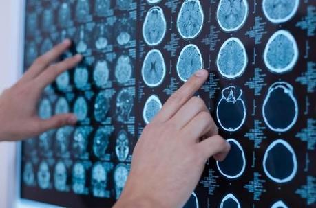Utiliser l’IRM pour prédire le risque de suicide | Science & Transhumanisme | Scoop.it