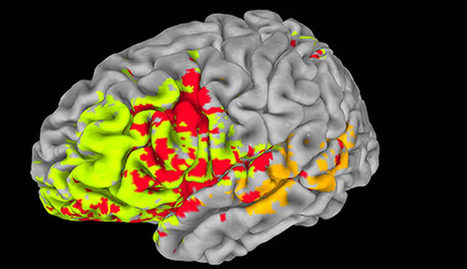 Researchers Use Brain Injury Data to Map Intelligence in the Brain | Science News | Scoop.it