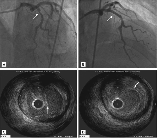 Rethinking Coronary Dissections in Drug-coated Balloon Angioplasty – A Paradigm Shift | Interventional Cardiology | Scoop.it