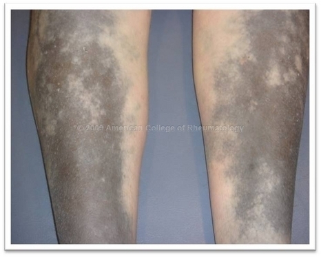 Rheumatology Image Library : Hydroxychloroquine Toxicity: Skin | Rheumatology-Rhumatologie | Scoop.it