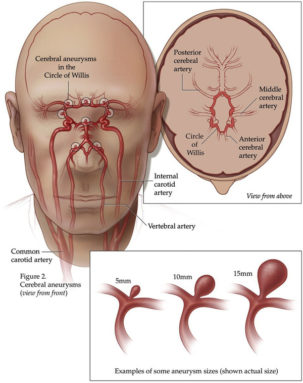 Endovascular treatment of brain aneurysms—is under 5mm a ‘go’ or ‘no-go’ area? | Neurovascular Intervention | Scoop.it