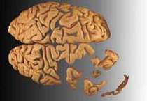 10 Conditions Misdiagnosed as Parkinson's Disease | #ALS AWARENESS #LouGehrigsDisease #PARKINSONS | Scoop.it