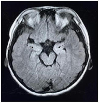 Frontiers | Clinical Characteristics and Follow-Up of Seizures in Children With Anti-NMDAR Encephalitis | Neurology | AntiNMDA | Scoop.it