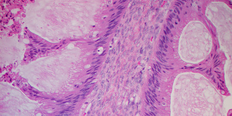 DNA Test Could Predict Ovarian Cancer Survival | Immunology Diagnosis | Scoop.it