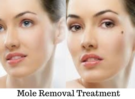 Mole Removal Sussex In Aureum Skin Skin Care Clinic Scoop It
