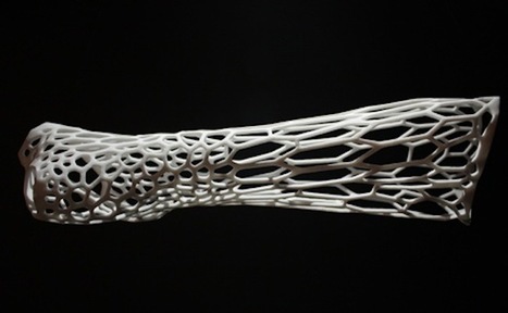 Impression 3D: Cortex réinvente le traitement des fractures osseuses | Veille sur les technologies d'impression 3D | Scoop.it