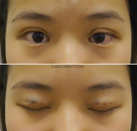 dst eyelid surgery