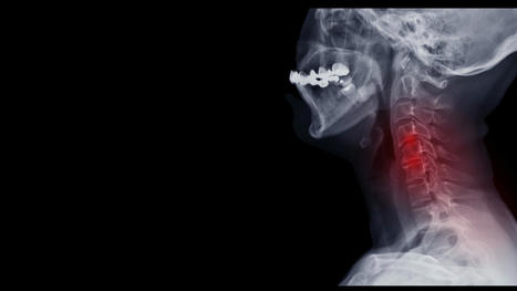 Cervical Spinal Fusion- What is it and What Should I Expect? | | Medical and Health | Scoop.it