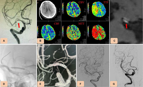 Endovascular treatment of symptomatic severe intracranial atherosclerotic stenosis with the NOVA intracranial dedicated drug-eluting stent | Neurovascular Intervention | Scoop.it