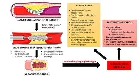 When stents become plaques: in-stent neoatherosclerosis | Interventional Cardiology | Scoop.it