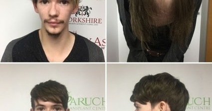 Hair Loss Solutions Method To Regain Strong An