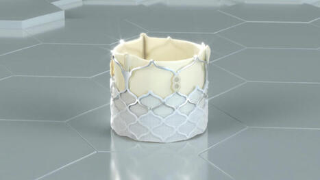 DurAVR transcatheter heart valve reaches 100 patients | Transcatheter Treatment of Mitral Regurgitation | Scoop.it