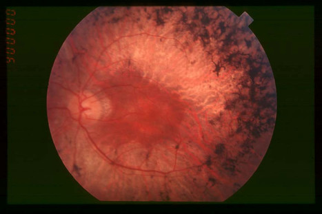 Marijuana May Prevent Blindness | Beckley News : Cannabis - Marijuana | Scoop.it