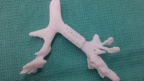 Imprimante 3D : Ils cr&eacute;ent une proth&egrave;se et sauvent la vie d&rsquo;un b&eacute;b&eacute; | Innovation & Technology | Scoop.it