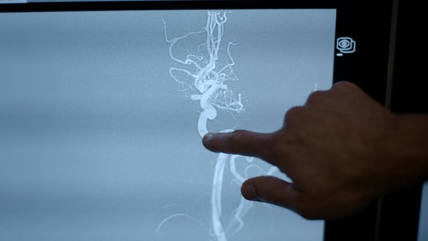 Mechanical Thrombectomy | Neurovascular Intervention | Scoop.it