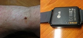 LG G Watch : certains utilisateurs se plaignent de corrosions pouvant aller jusqu'à blesser le poignet | Toxique, soyons vigilant ! | Scoop.it