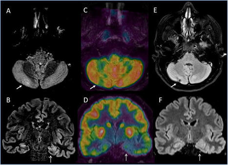 PET coregistered with MRI imaging of anti-NMDAR encephalitis patient with SARS-CoV-2 infection | AntiNMDA | Scoop.it