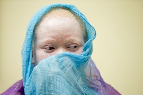 ‘We are being hunted like animals': Malawi’s albino people are threatened by human poachers | consumer psychology | Scoop.it