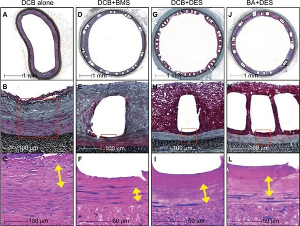 When biology drives benefit: how lesion morphology shapes DCB response | Interventional Cardiology | Scoop.it