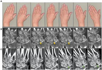 Frontiers | Four-dimensional computed tomography detects dynamic three-dimensional pathologies of the wrist in patients with calcium pyrophosphate deposition disease | Rheumatology-Rhumatologie | Scoop.it