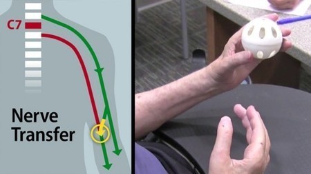 Partial Hand Function Restored in Quadriplegic Patient | Longevity science | Scoop.it