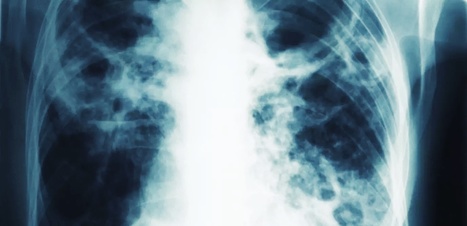 Nouvel Obs : "La tuberculose, «maladie de la pauvreté», fait son retour en France | Ce monde à inventer ! | Scoop.it