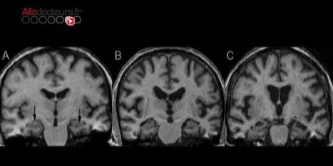 Augmentation des décès associés à la maladie d'Alzheimer aux Etats-Unis | Alzheimer, maladies neuro-dégénératives et gérontologie générale | Scoop.it