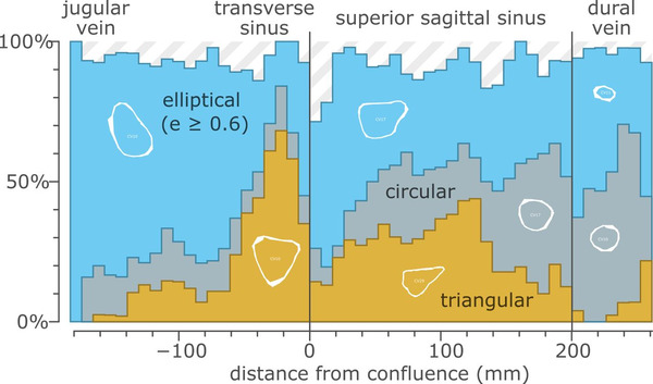 Characterizing superficial cerebral cortical venous anatomy for endovascular device implantation: a cross-sectional imaging study | Brain Computer Interfaces & connected medical devices | Scoop.it