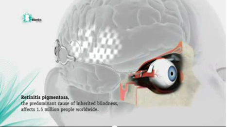 Implantan con éxito ojo biónico a paciente de 54 años | Salud Visual 2.0 | Scoop.it