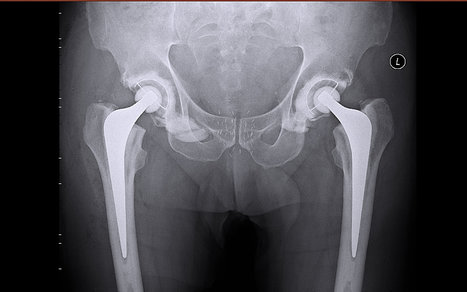 Surprise Path to Better Sex: Hip Surgery | Doctor Data | Scoop.it