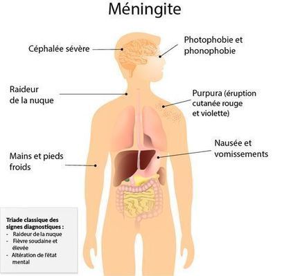 Les méningites de l'adulte et du grand enfant - Symptômes et traitement | Santé, prévention, maladies, patients | Scoop.it