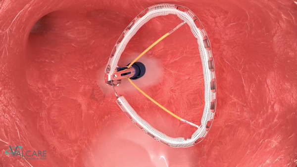 First patients enrolled in AMEND TS pilot study | Transcatheter Treatment of Mitral Regurgitation | Scoop.it