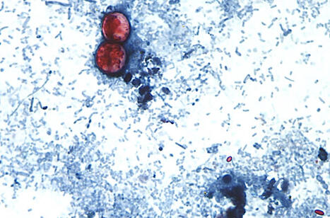 Why cyclospora can be deadly for some people - wgntv.com | Operation Deimos | Scoop.it