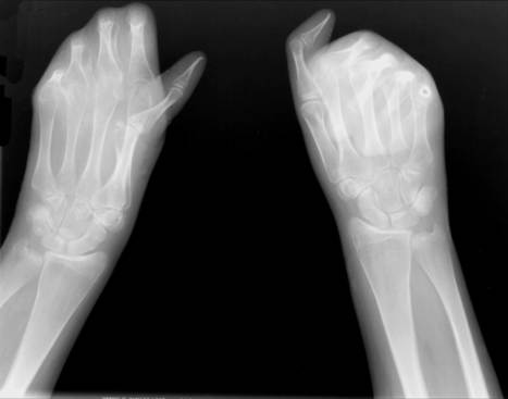 Recessive Dystrophic Epidermolysis Bullosa: Advances in the Laboratory Leading to New Therapies | Vectorology - GEG Tech top picks | Scoop.it