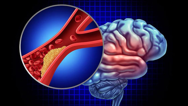 IA Thrombolysis After Thrombectomy: More Uncertainty | Neurovascular Intervention | Scoop.it