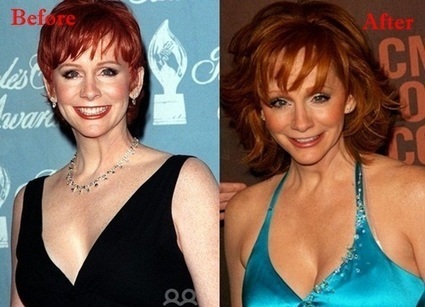 Reba McEntire Plastic Surgery Before and After 