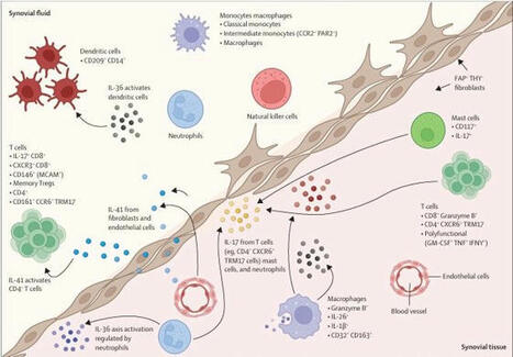 Advancing understanding of psoriatic arthritis through synovial research | The Lancet Rheumatology posted on the topic | LinkedIn | Rheumatology-Rhumatologie | Scoop.it