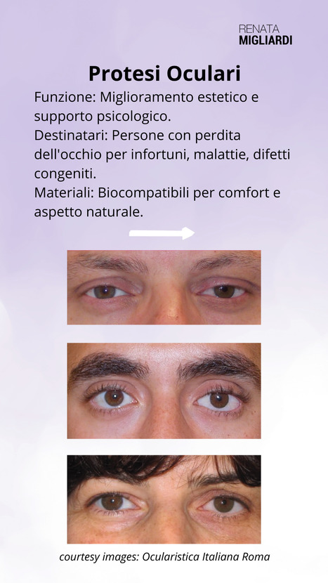 Protesi oculare Torino - oculoplastica | Dr. Renata Migliardi | The Eye News | Scoop.it