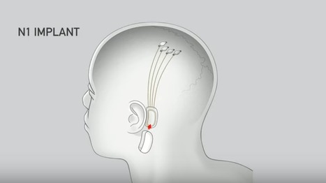 Neurologen an Elon Musk: Neuralinks Hirn-Implantat ist "unseriöser Hype" | Upgrading humans | Scoop.it