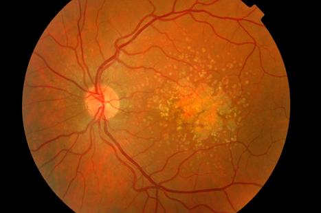 Congreso AAOPT 12, Phoenix. Actualización en DMAE. | Formación Optometristas 2.0 | Scoop.it