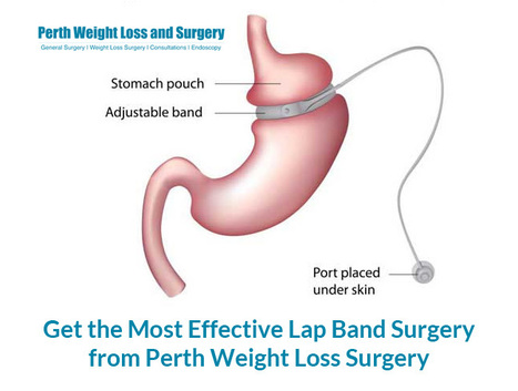 Perth Weight Loss Surgery Scoop It