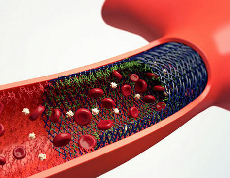 HPC: Hydrophilic Polymer Coating | Neurovascular Intervention | Scoop.it
