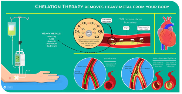 IV Chelation Therapy - Heavy Metal Treatment | Interventional Cardiology | Scoop.it
