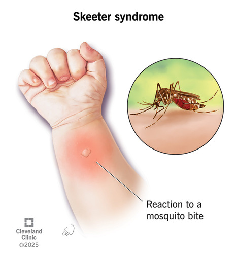 Ces personnes qui d&eacute;veloppent une r&eacute;action allergique s&eacute;v&egrave;re aux piq&ucirc;res de moustiques | EntomoNews | Scoop.it